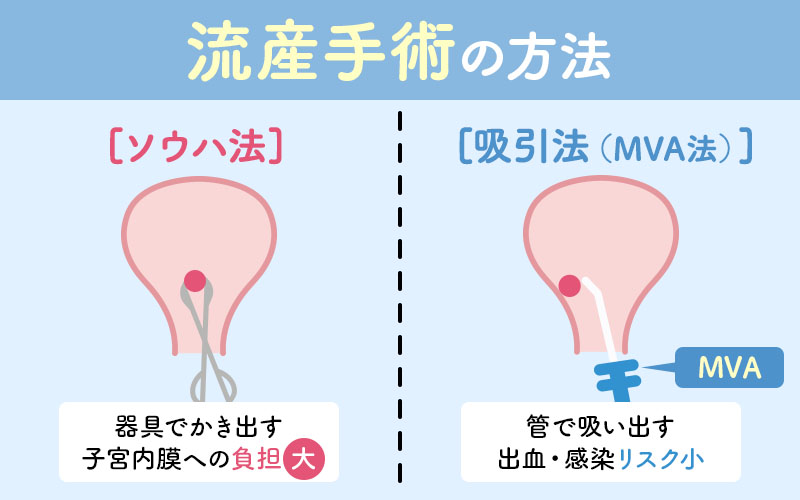 流産手術の方法|ソウハ法と吸引法